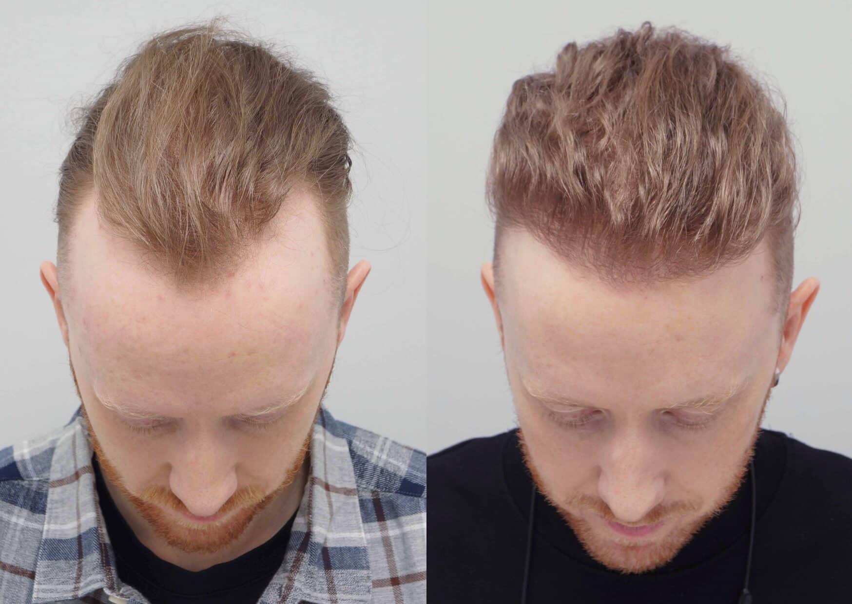 Hair transplant uk